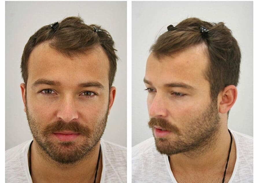 hair transplant cost london